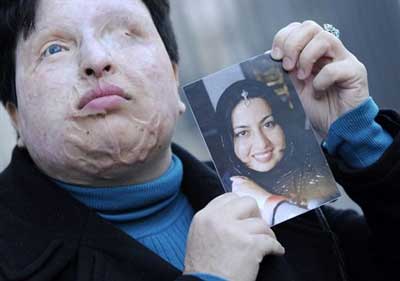 Condanna decisa secondo la legge del taglione: acido negli occhi. La donna sfigurata salva Majid Moyahedi
